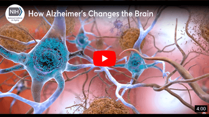 How Alzheimer's Changes the Brain © National Institute on Aging (NIA)